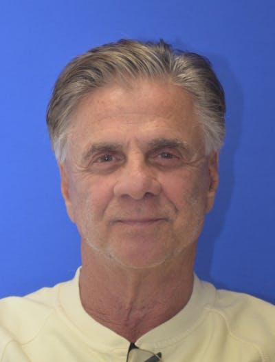 Face Lift Before & After Gallery - Patient 180821 - Image 2