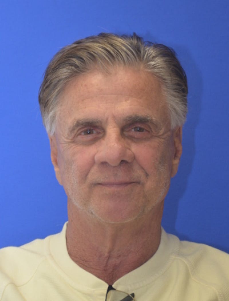 Face Lift Before & After Gallery - Patient 180821 - Image 2