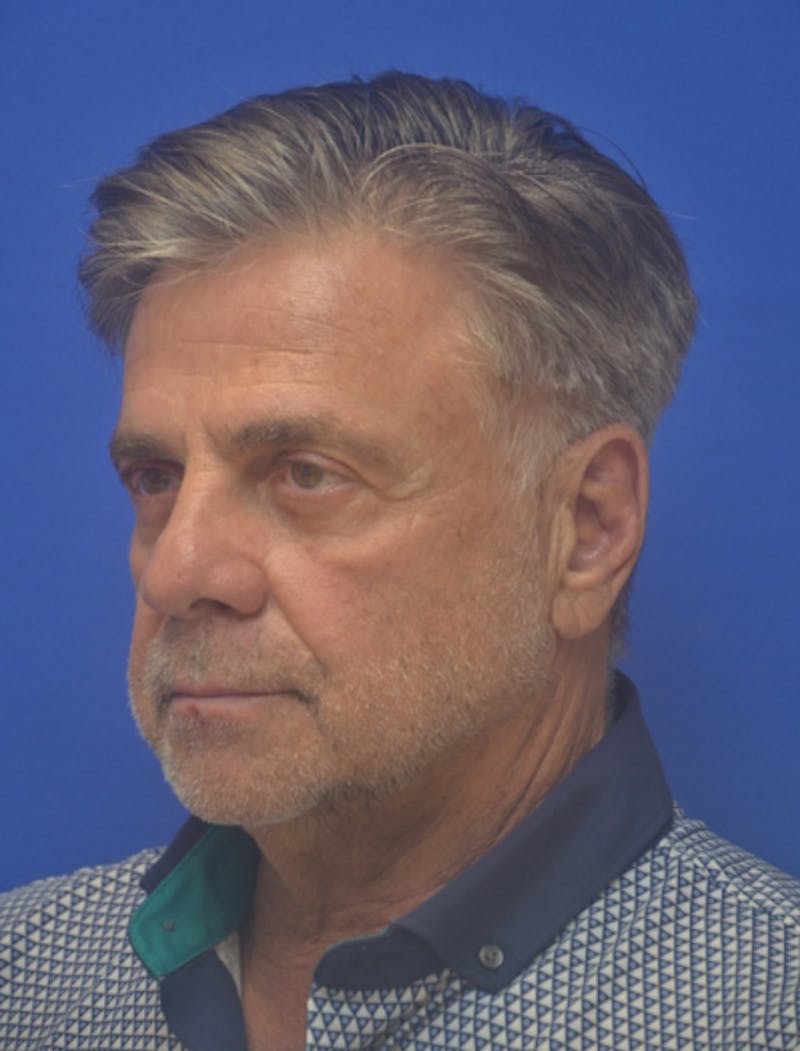 Face Lift Before & After Gallery - Patient 180821 - Image 3