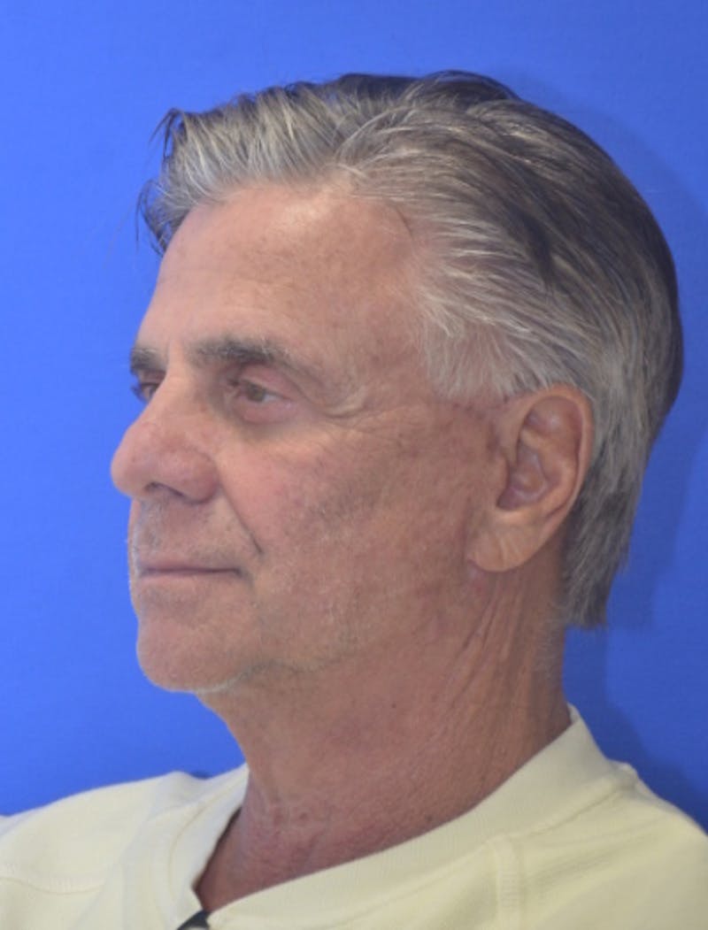Face Lift Before & After Gallery - Patient 180821 - Image 4