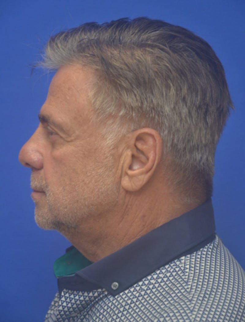 Face Lift Before & After Gallery - Patient 180821 - Image 5
