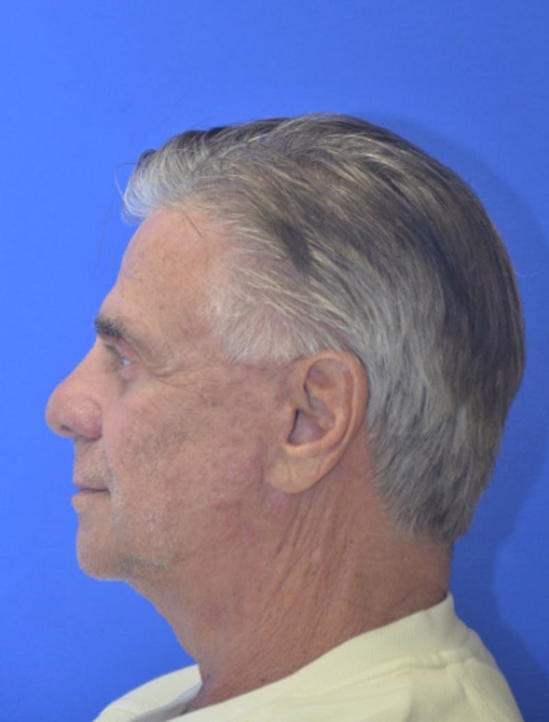 Face Lift Before & After Gallery - Patient 180821 - Image 6