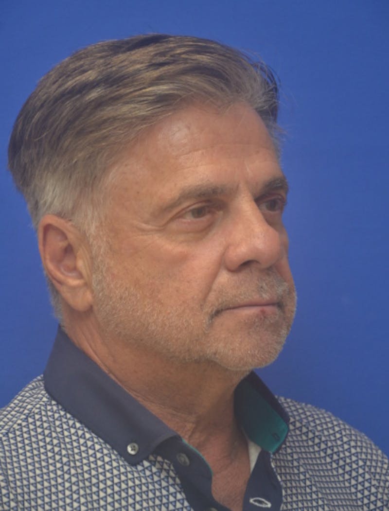 Face Lift Before & After Gallery - Patient 180821 - Image 7