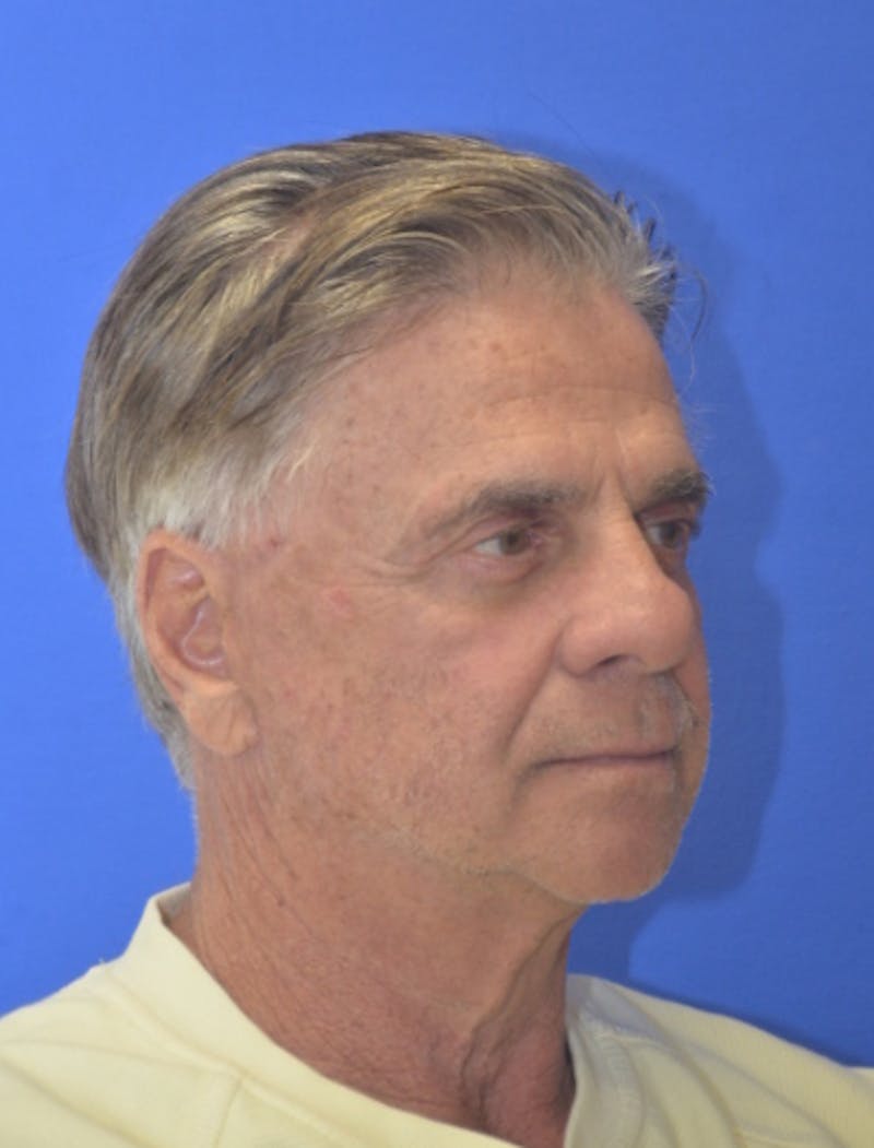 Face Lift Before & After Gallery - Patient 180821 - Image 8