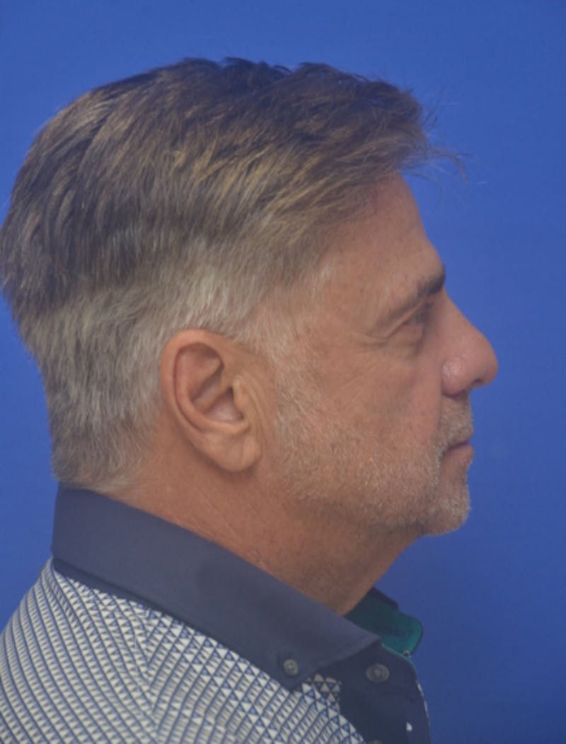 Face Lift Before & After Gallery - Patient 180821 - Image 9