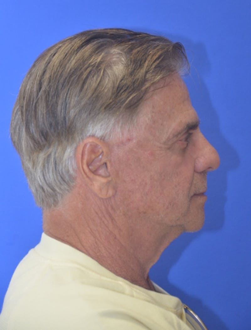 Face Lift Before & After Gallery - Patient 180821 - Image 10