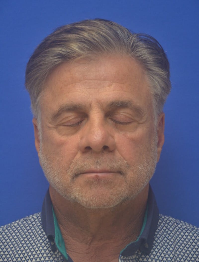Face Lift Before & After Gallery - Patient 180821 - Image 11