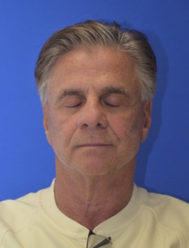 Face Lift Before & After Gallery - Patient 180821 - Image 12