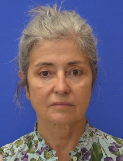 Face Lift Before & After Gallery - Patient 546480 - Image 1