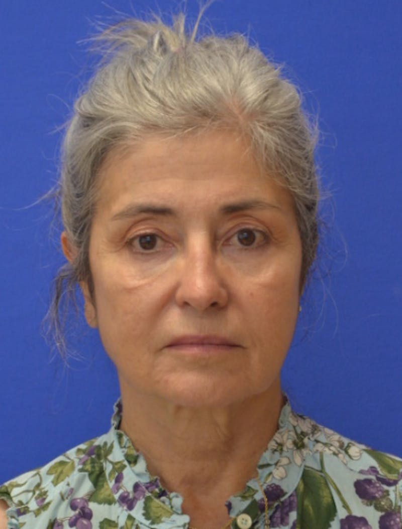 Face Lift Before & After Gallery - Patient 546480 - Image 1