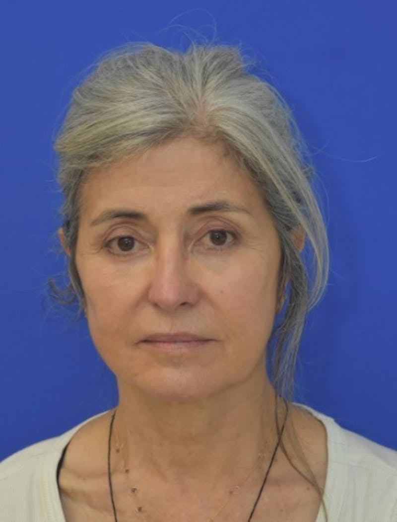 Face Lift Before & After Gallery - Patient 546480 - Image 2