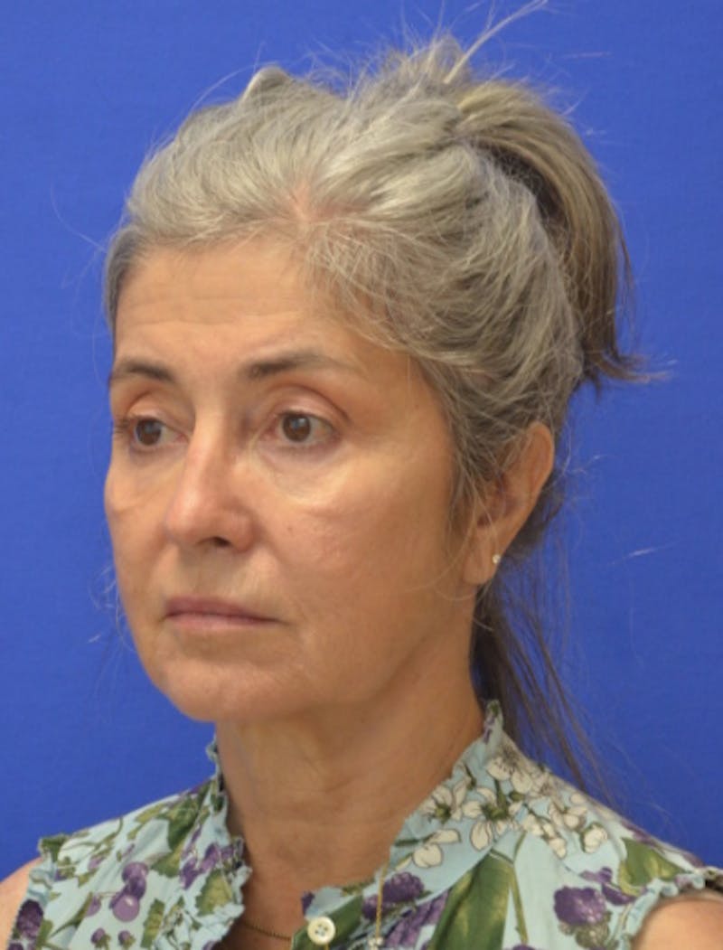 Face Lift Before & After Gallery - Patient 546480 - Image 3
