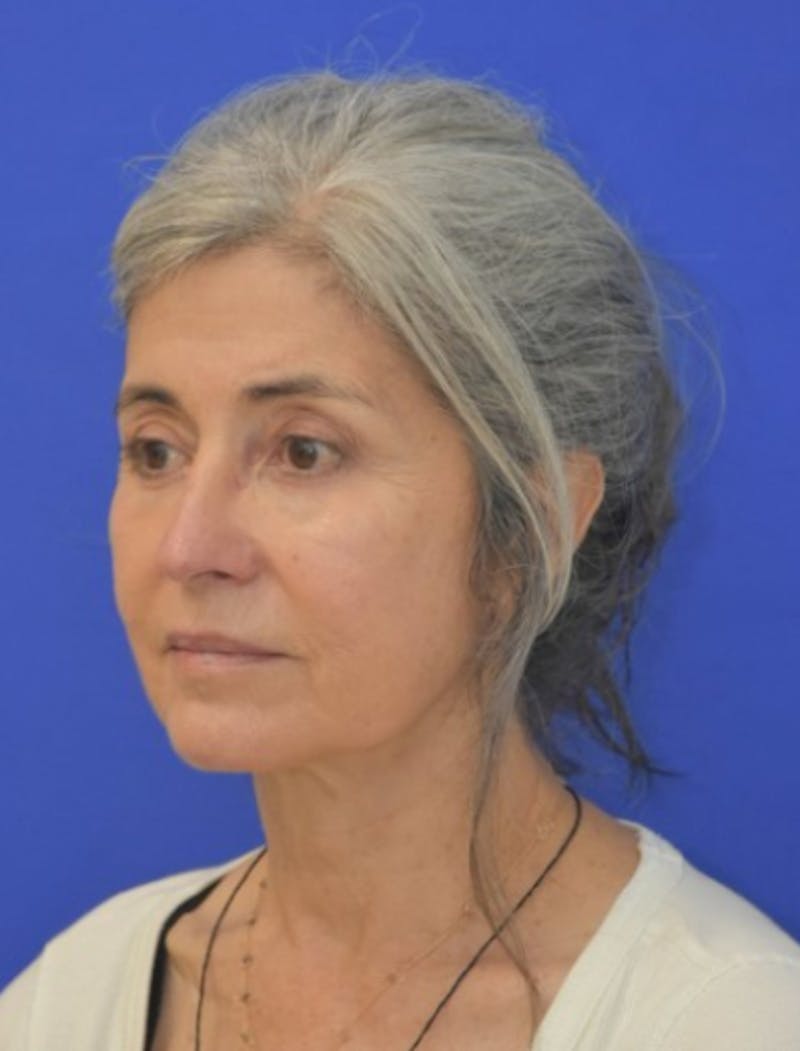Face Lift Before & After Gallery - Patient 546480 - Image 4