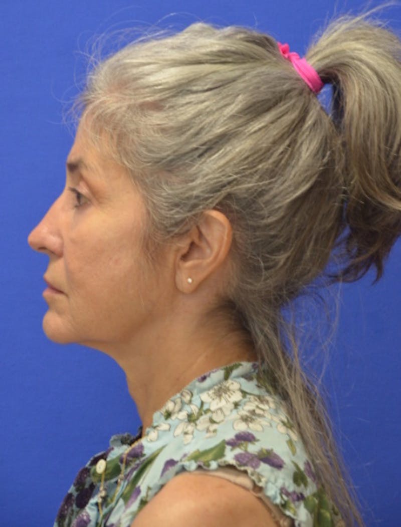 Face Lift Before & After Gallery - Patient 546480 - Image 5
