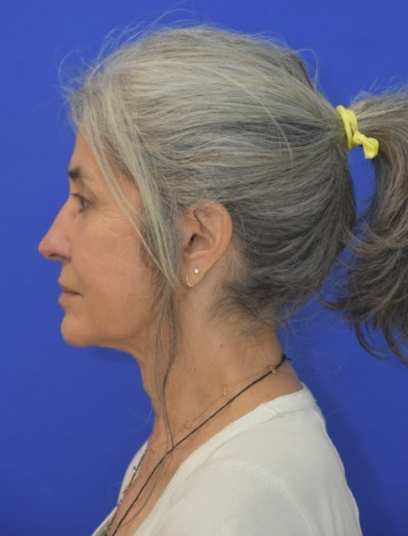 Face Lift Before & After Gallery - Patient 546480 - Image 6
