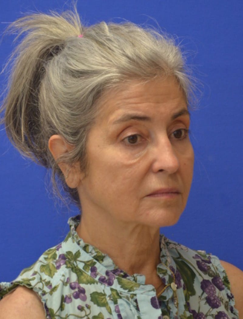 Face Lift Before & After Gallery - Patient 546480 - Image 7