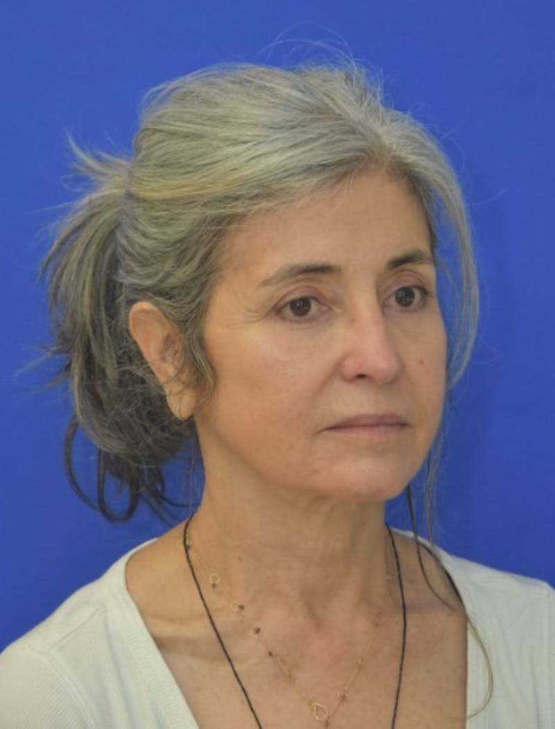 Face Lift Before & After Gallery - Patient 546480 - Image 8