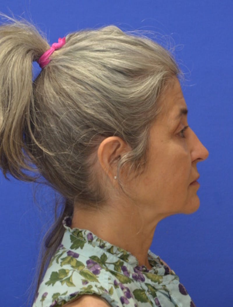 Face Lift Before & After Gallery - Patient 546480 - Image 9