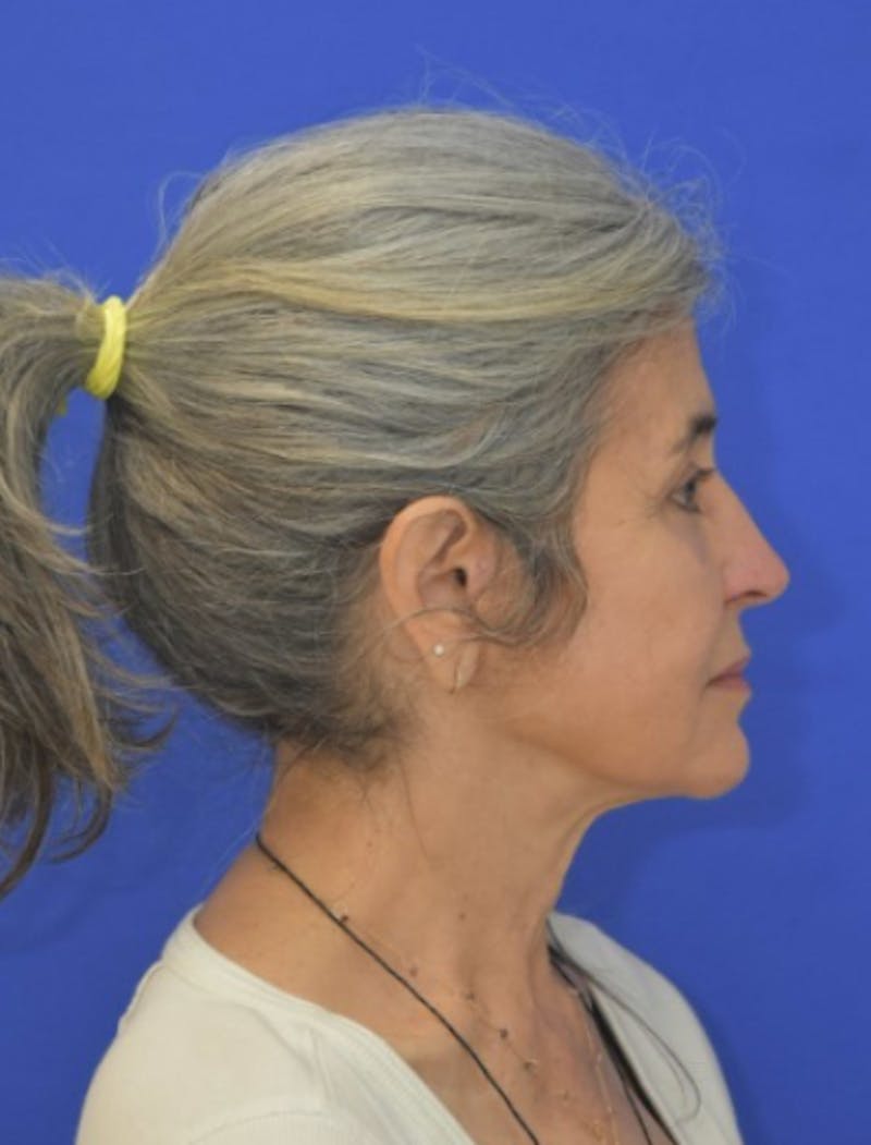 Face Lift Before & After Gallery - Patient 546480 - Image 10