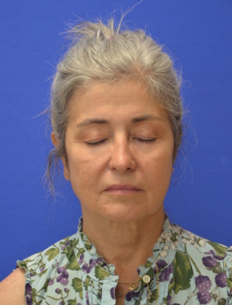 Face Lift Before & After Gallery - Patient 546480 - Image 11