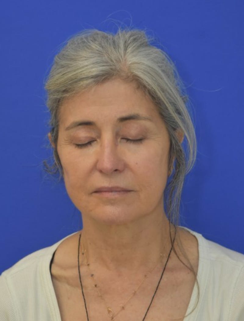 Face Lift Before & After Gallery - Patient 546480 - Image 12