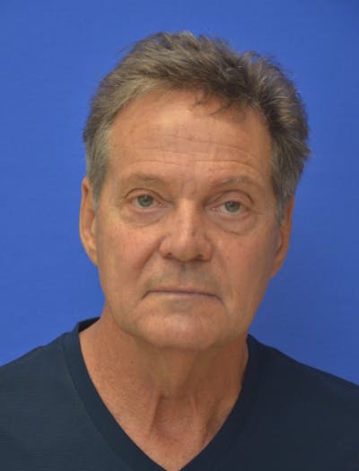 Face Lift Before & After Gallery - Patient 158647 - Image 1