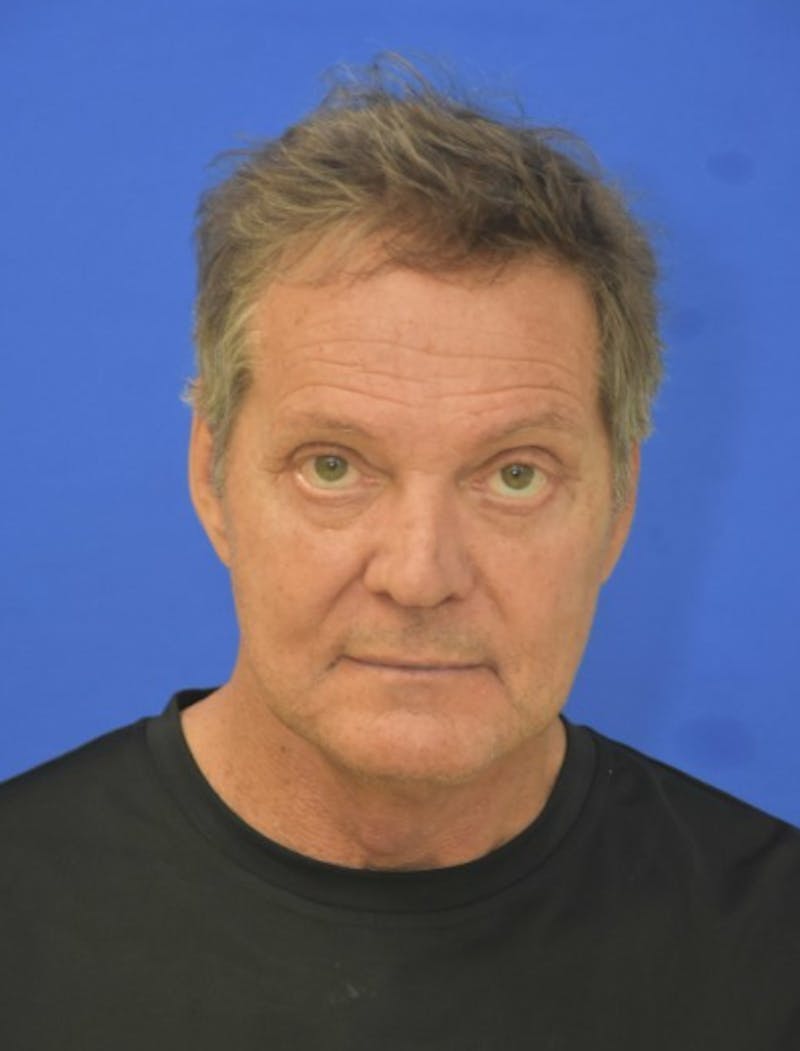 Face Lift Before & After Gallery - Patient 158647 - Image 2