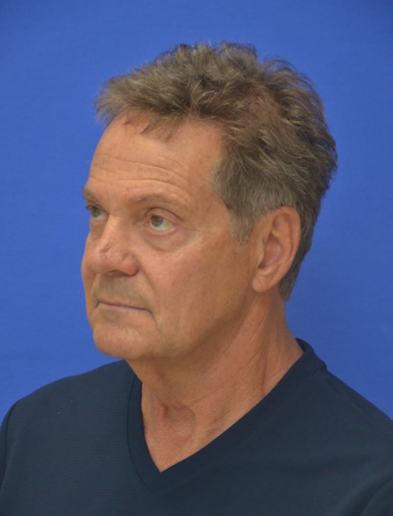 Face Lift Before & After Gallery - Patient 158647 - Image 3