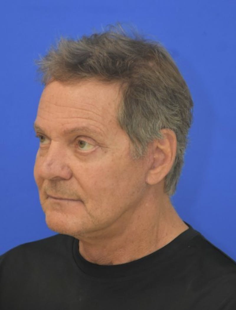 Face Lift Before & After Gallery - Patient 158647 - Image 4