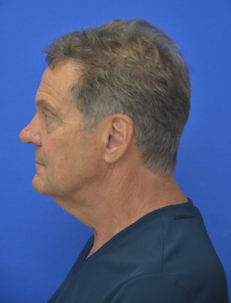 Face Lift Before & After Gallery - Patient 158647 - Image 5
