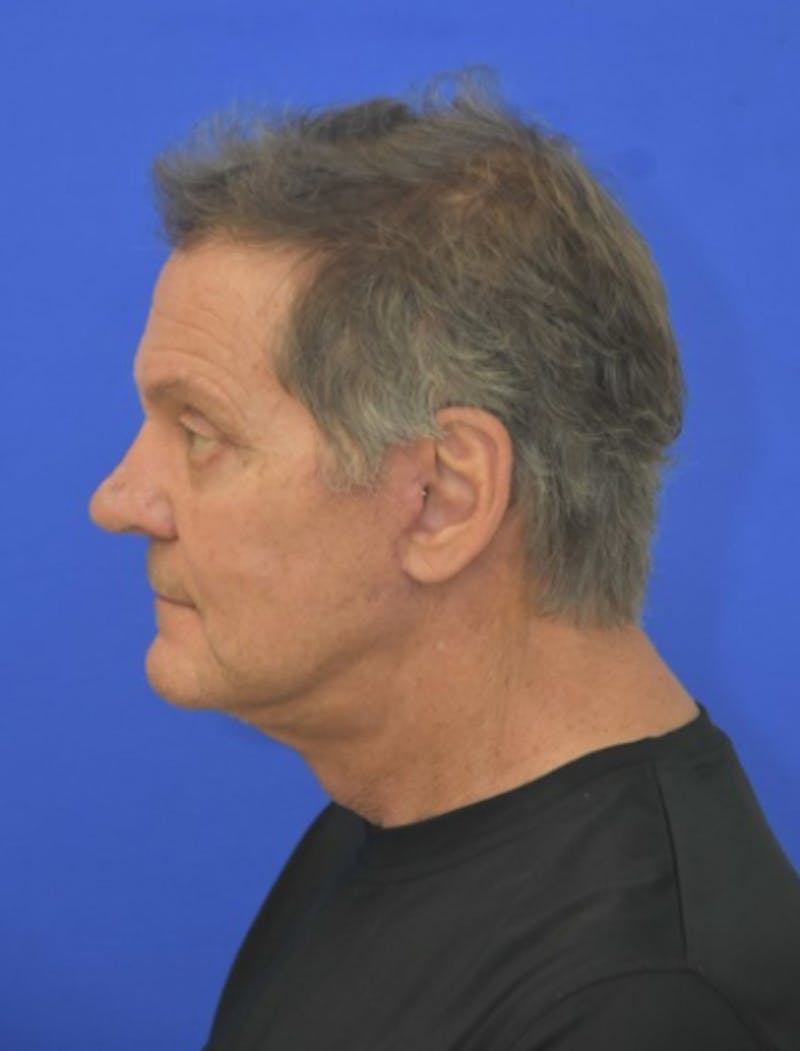 Face Lift Before & After Gallery - Patient 158647 - Image 6
