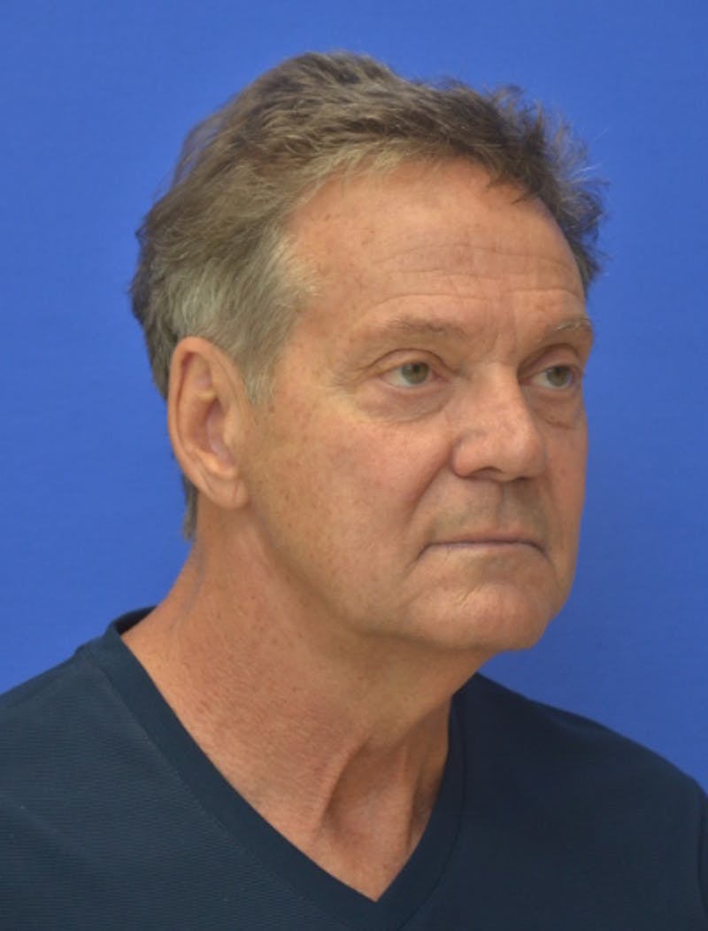 Face Lift Before & After Gallery - Patient 158647 - Image 7
