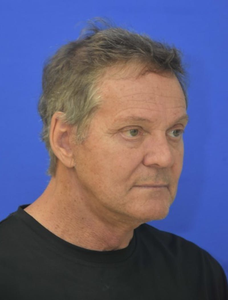 Face Lift Before & After Gallery - Patient 158647 - Image 8