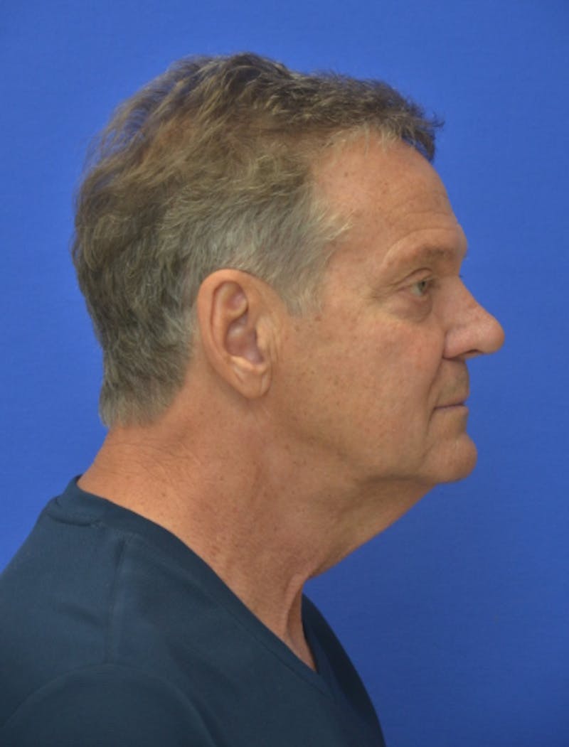 Face Lift Before & After Gallery - Patient 158647 - Image 9