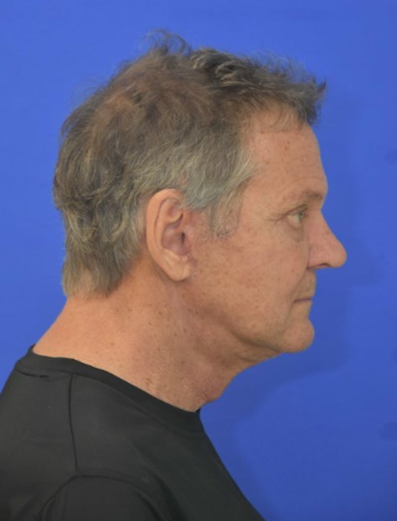 Face Lift Before & After Gallery - Patient 158647 - Image 10