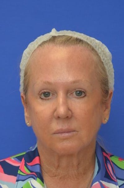 Facelift Before & After Gallery - Patient 394548 - Image 1