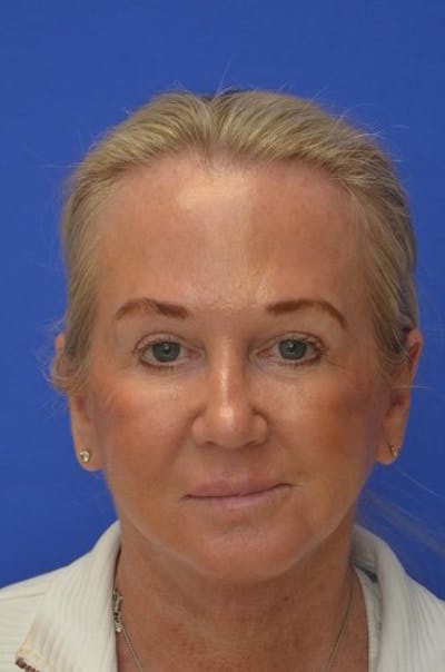 Facelift Before & After Gallery - Patient 394548 - Image 2