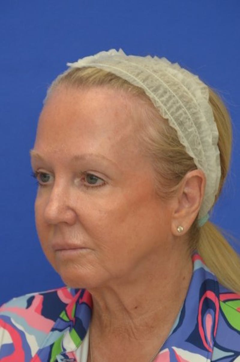 Face Lift Before & After Gallery - Patient 394548 - Image 3