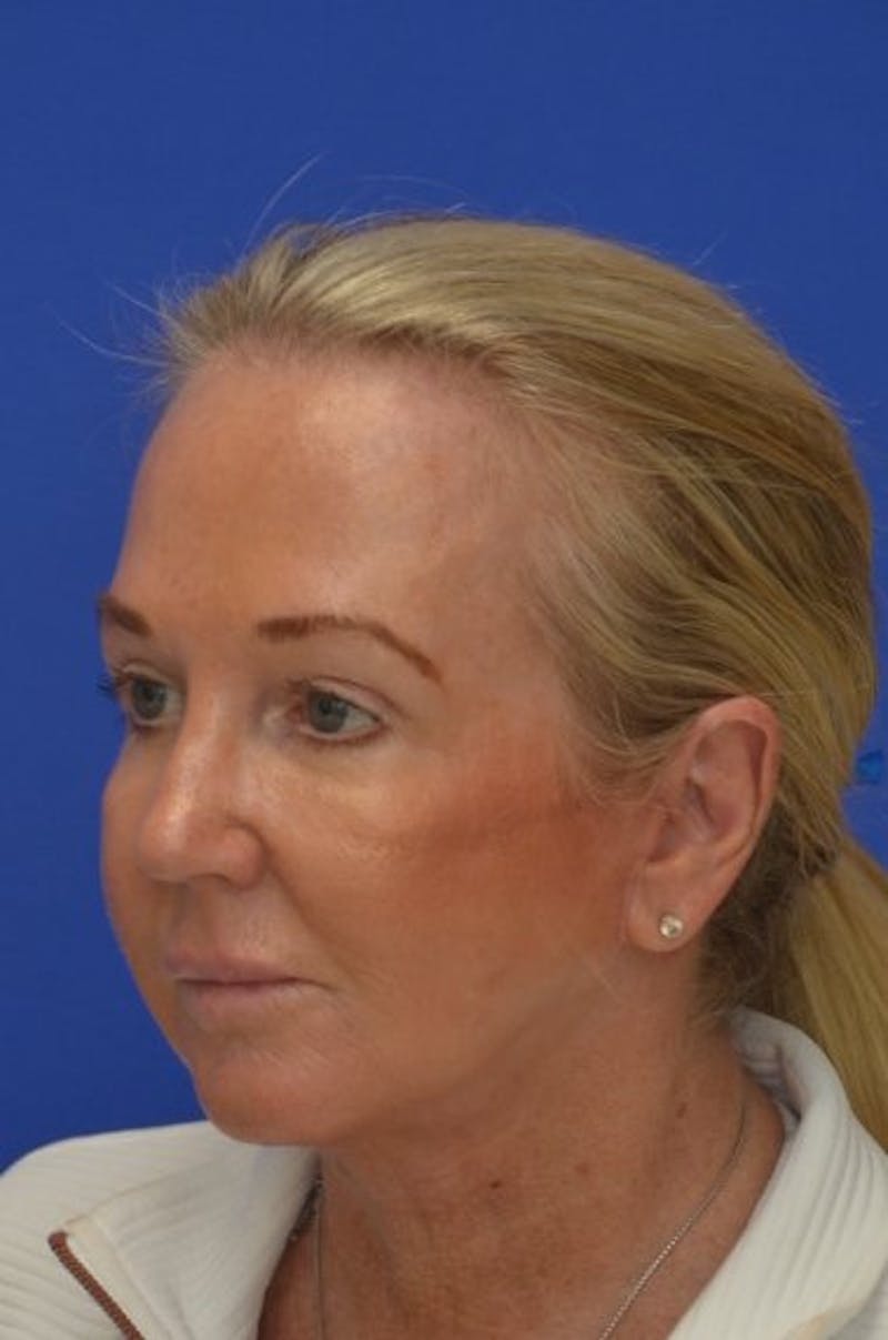 Face Lift Before & After Gallery - Patient 394548 - Image 4
