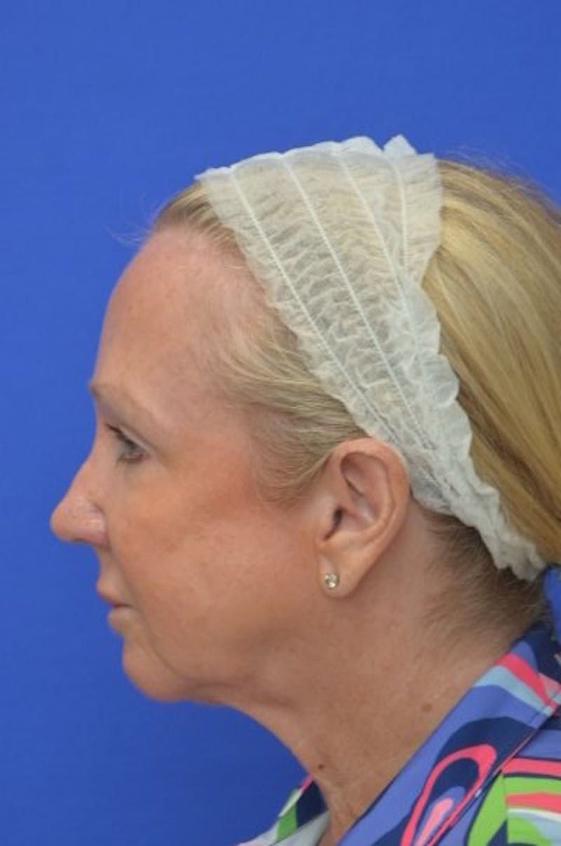 Face Lift Before & After Gallery - Patient 394548 - Image 5