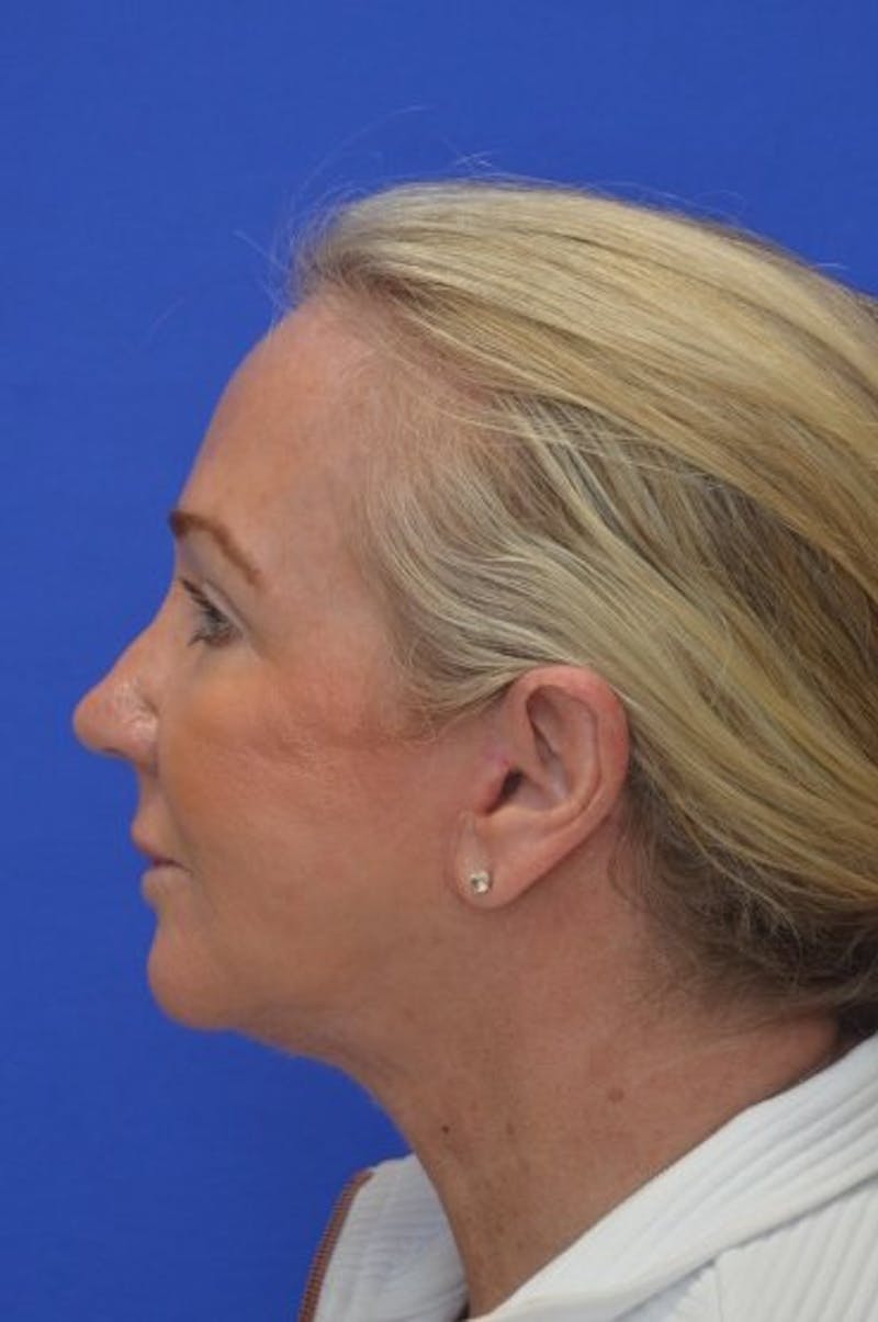 Face Lift Before & After Gallery - Patient 394548 - Image 6