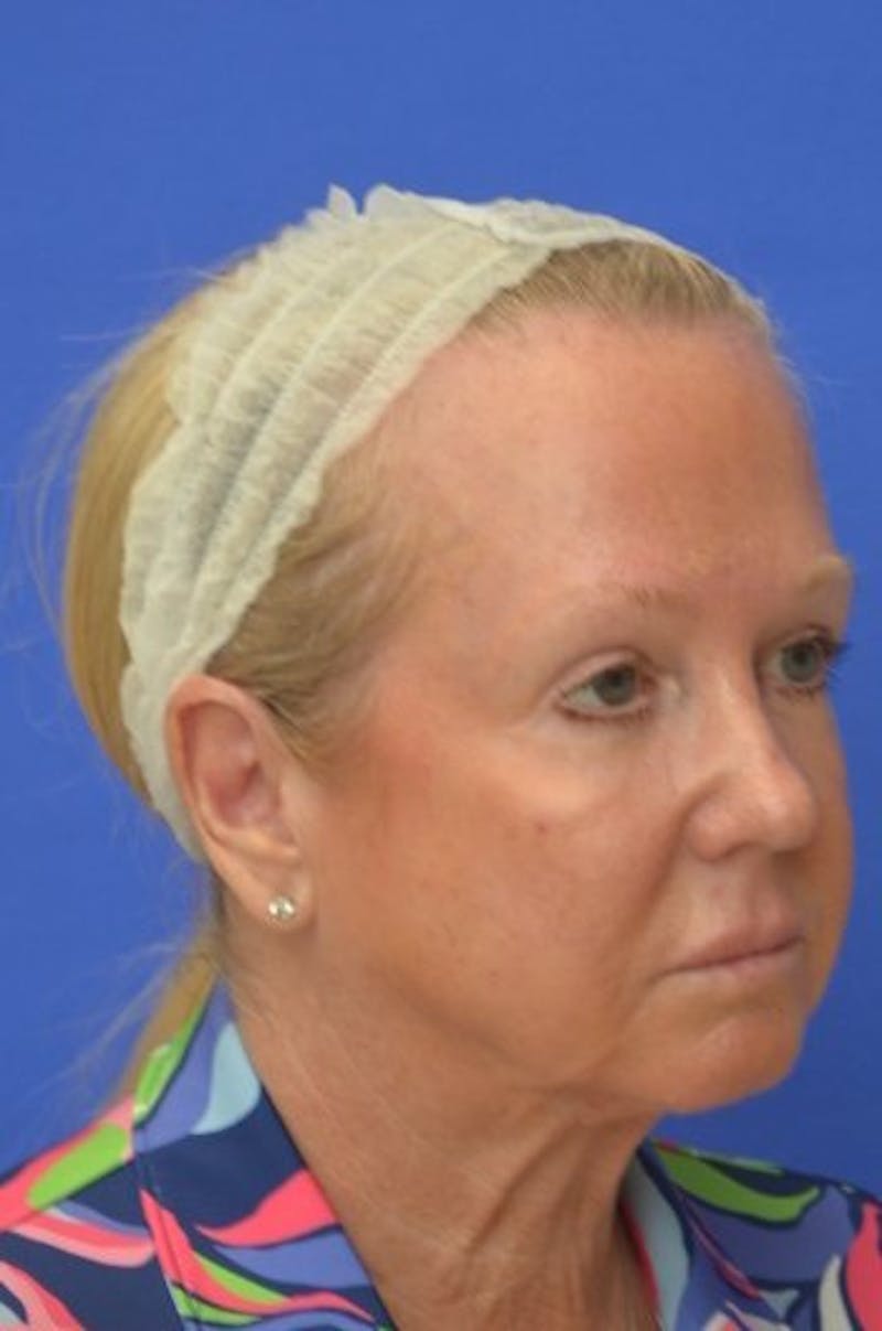 Face Lift Before & After Gallery - Patient 394548 - Image 7