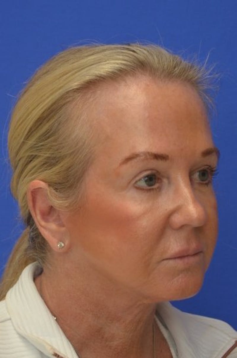 Face Lift Before & After Gallery - Patient 394548 - Image 8