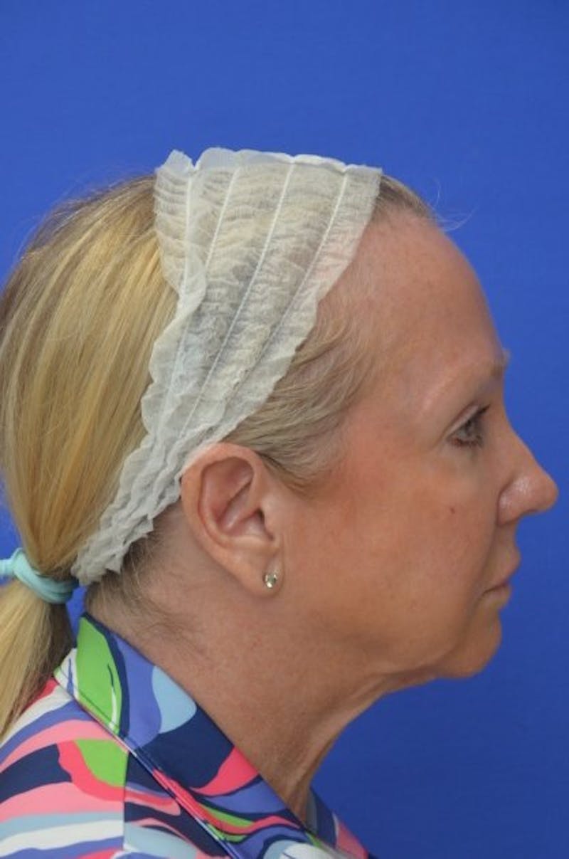 Face Lift Before & After Gallery - Patient 394548 - Image 9