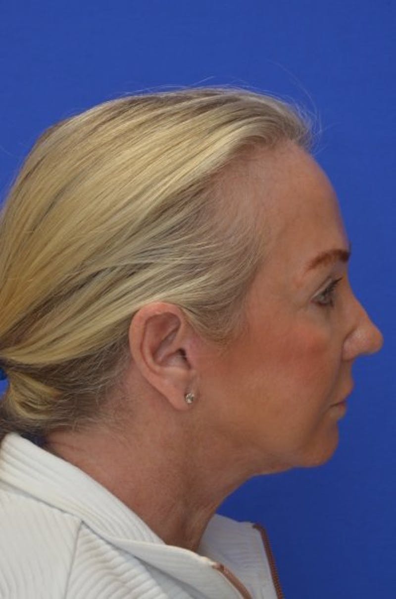 Face Lift Before & After Gallery - Patient 394548 - Image 10