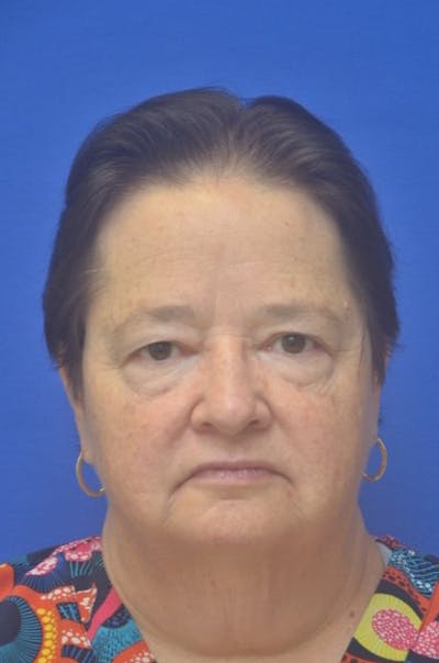 Face Lift Before & After Gallery - Patient 373234 - Image 1