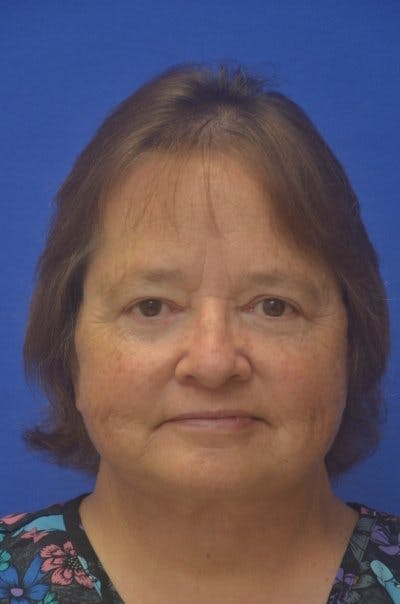 Face Lift Before & After Gallery - Patient 373234 - Image 2