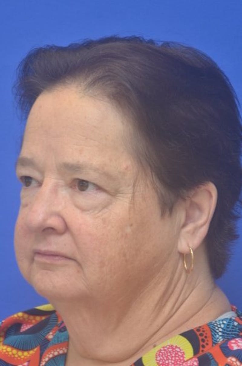 Face Lift Before & After Gallery - Patient 373234 - Image 3