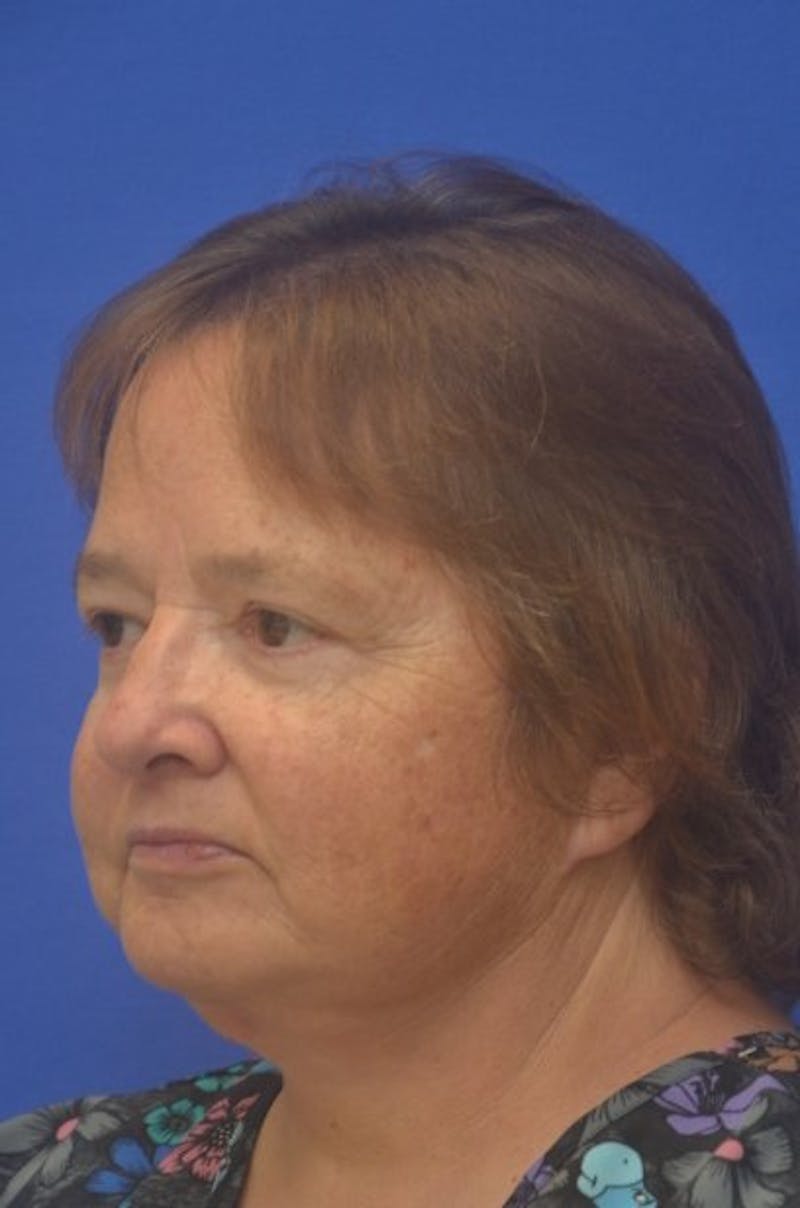 Face Lift Before & After Gallery - Patient 373234 - Image 4