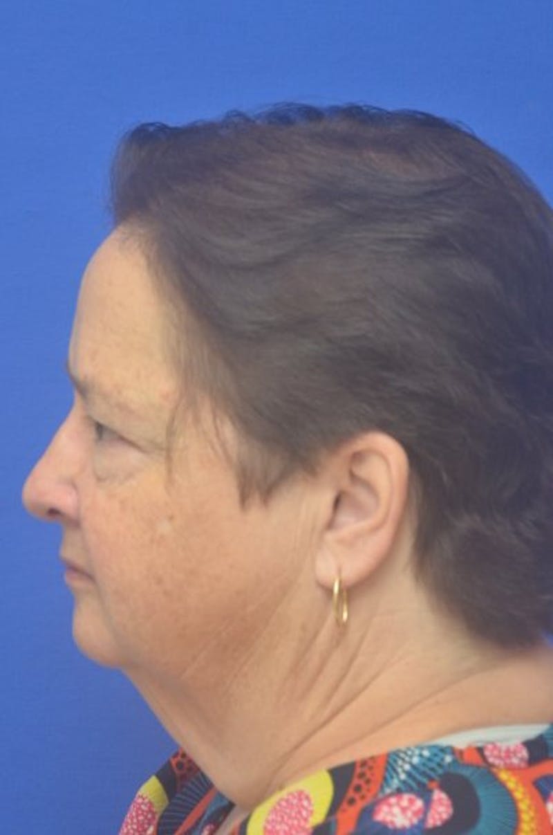 Face Lift Before & After Gallery - Patient 373234 - Image 5